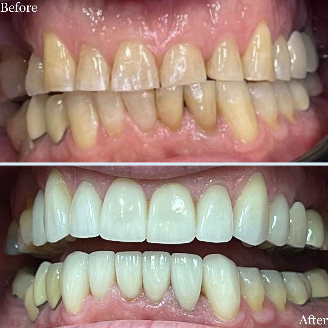 Before and after photo of Invisalign case