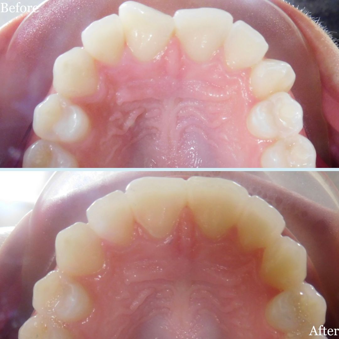 Before and after photo of Invisalign case