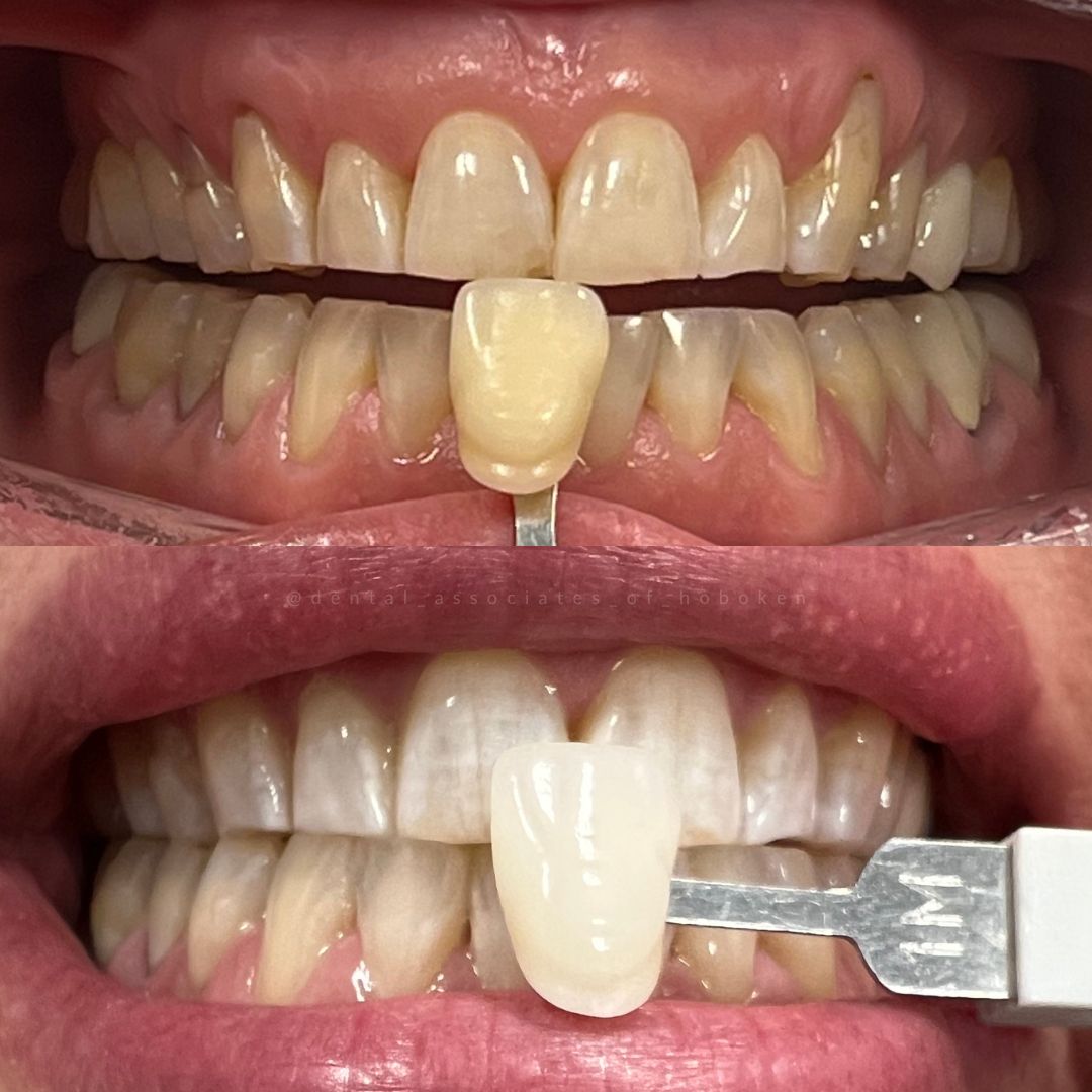 Tooth whitening comparison 